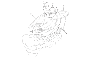 Stomach_Catheter